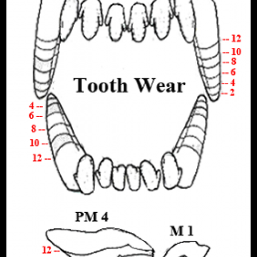 Tooth Wear.png