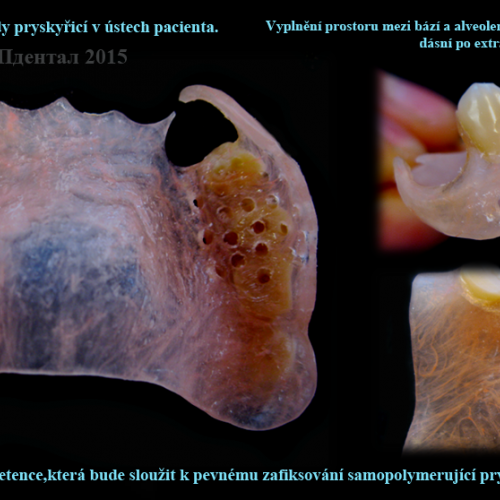38 Oprava polyamidové náhrady pryskyřicí v ústech pacienta.Vyplnění prostoru mezi bází a alveolem..p