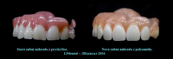 4 Srovnání staré klasické náhrady s novou zhotovenou nadstandardně..png