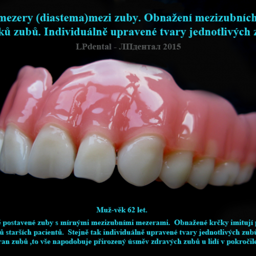 14 Mezizubní mezery-obnažené krčky zubů -individuální úprava tvarů zubů..png