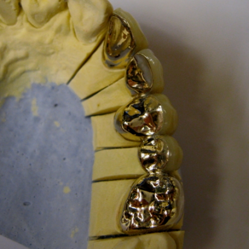 12 LP dental-fasetovaný můstek-kombinace pryskyřice na zlaté konstrukci,slitina Aurix.png
