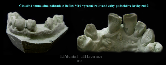 1 Částečná náhrada z Deflex M10-výrazně rotované zuby-podsekřivé krčky zubů..png