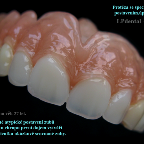 41 Protéza se specifickým individuálním postavením,úpravou a barvou zubů..png