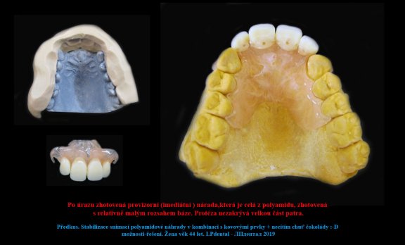 1 Předkus. Stabilizace snímací polyamidové náhrady v kombinaci s kovovými prvky 