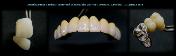 Korunky a můstky fasetované kompozitním plastem - Chromasit..png