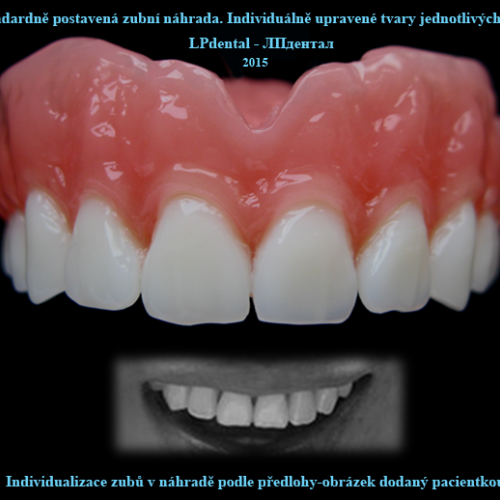 2 Standardně postavená zubní náhrada.Individuálně upravené tvary jednotlivých zubů..png