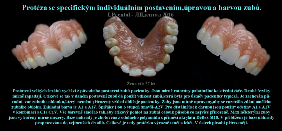 7-2 Protéza se specifickým individuálním postavením,úpravou a barvou zubů..png